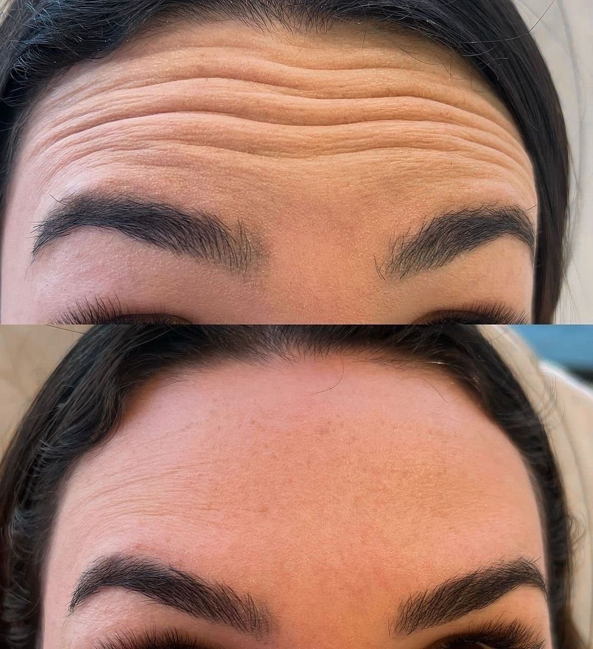 بوتوكس التجاعيد